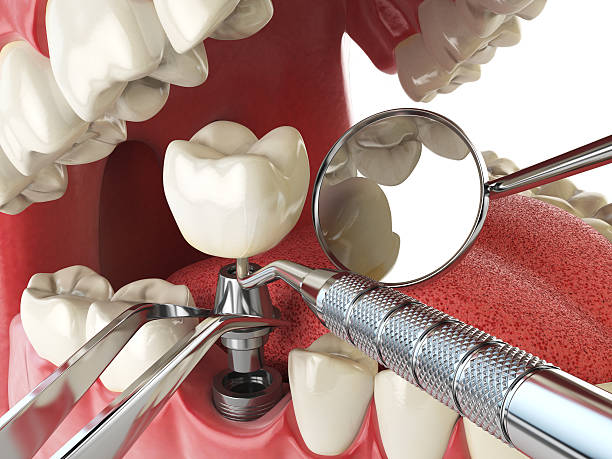 Best Emergency Tooth Extraction in Irwin, SC